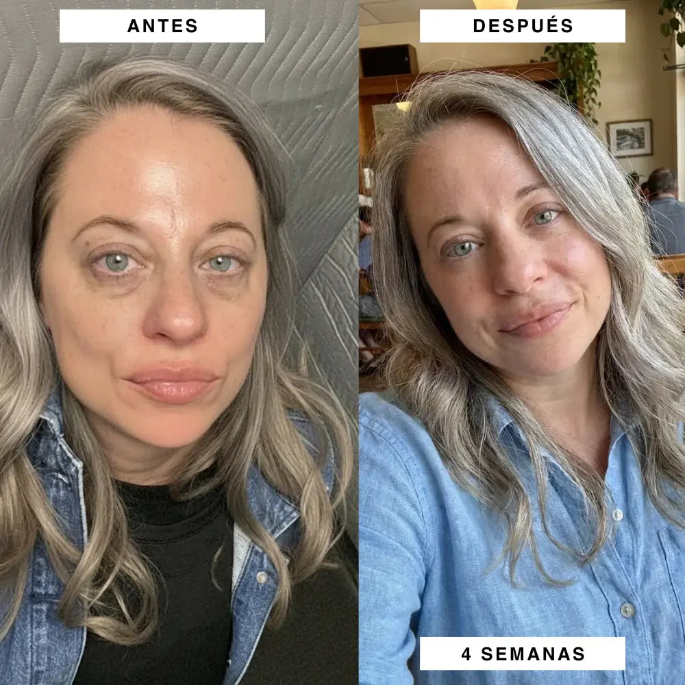 Tratamiento de Microagujas