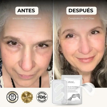 Tratamiento de Microagujas